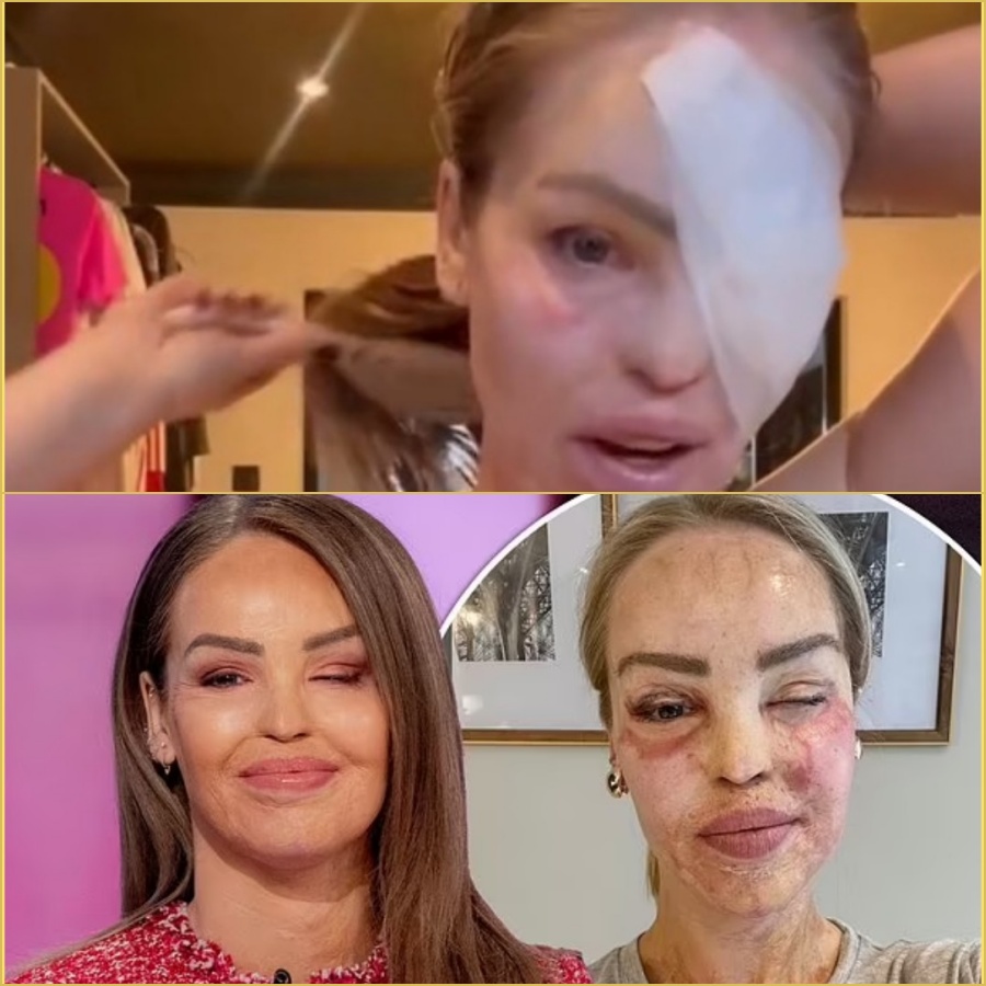 Katie Piper has once again undergone eye surgery, nearly 17 years after living with the severe, life-changing effects of the 2008 attack. After years of surgeries and stares, Katie Piper admits a simple bandage feels like a rare day off. Honest, brave and still inspiring millions  DD